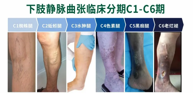 警惕！高温来了，静脉曲张患者该如何度夏