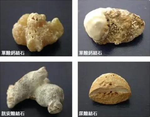 探讨结石精准治疗，解密结石“前世今生”