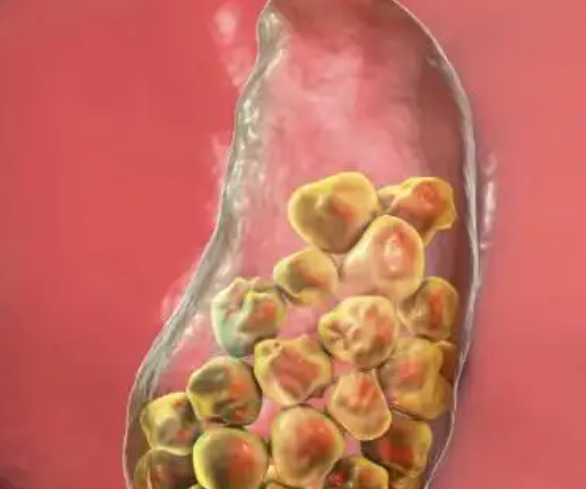 长期不早餐，小心胆囊结石找上门！