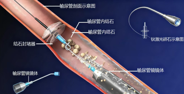 别等“喊疼”才想起检查！不痛的结石更危险