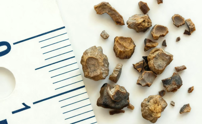 遇上“十级痛”的结石，到底该如何治疗？