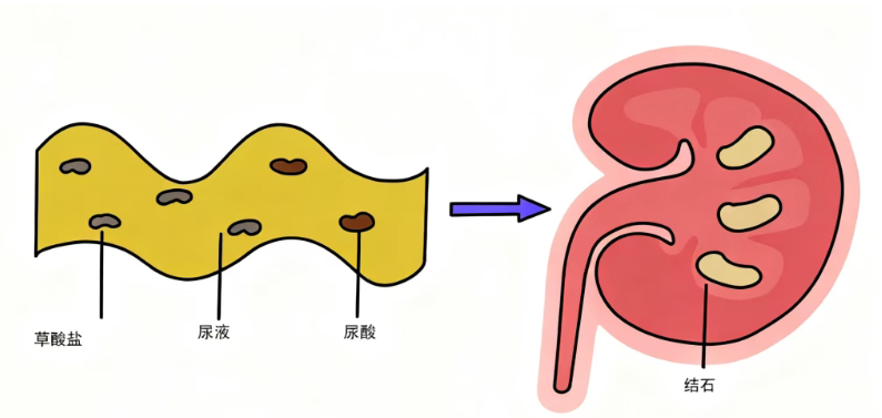 长期憋尿：别让 “忍一时”，变成身体的 “大麻烦”