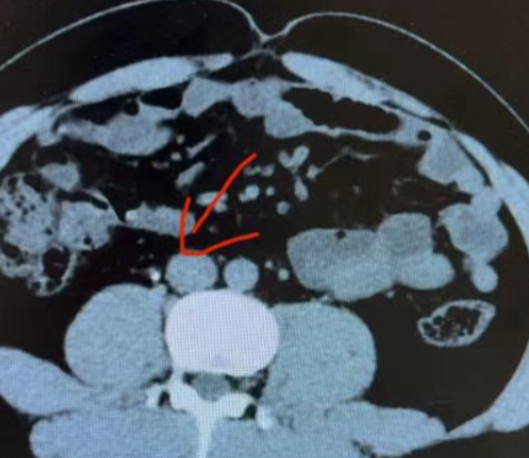 肾结石有多痛？没经历过的人，很难想象......
