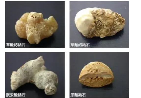 这些症状，可能是结石在 “作祟”