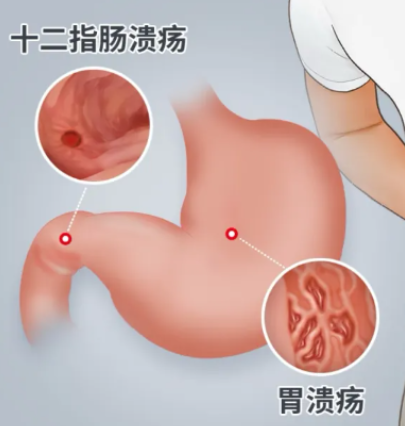 肠胃发出的这些预警信号，  你读懂了吗？