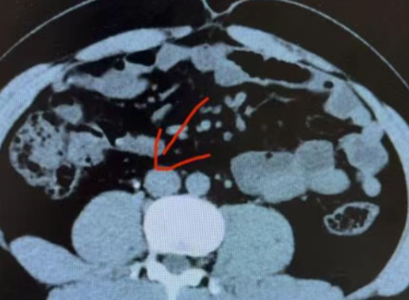 肾结石有多痛？没经历过的人，很难想象......