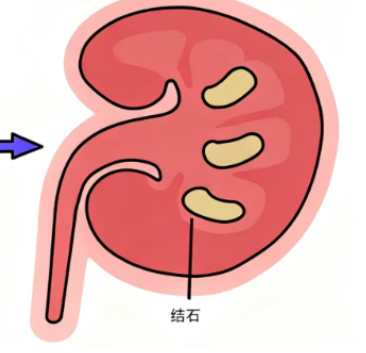 长期刻意憋尿，不仅会让膀胱 “受伤”，还可能悄悄催生一个更麻烦的问题 ——泌尿结石