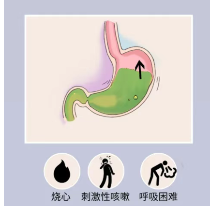 反酸、烧心、干咳，一种「胃病」灼伤一亿中国人