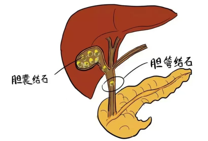 冬季胆结石易 “作乱”！4 件事千万别做，护好胆囊少遭罪