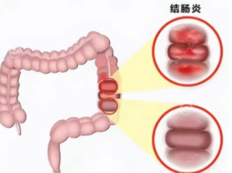 40 岁后必看！从排便异常到肠癌风险，很多人不当回事