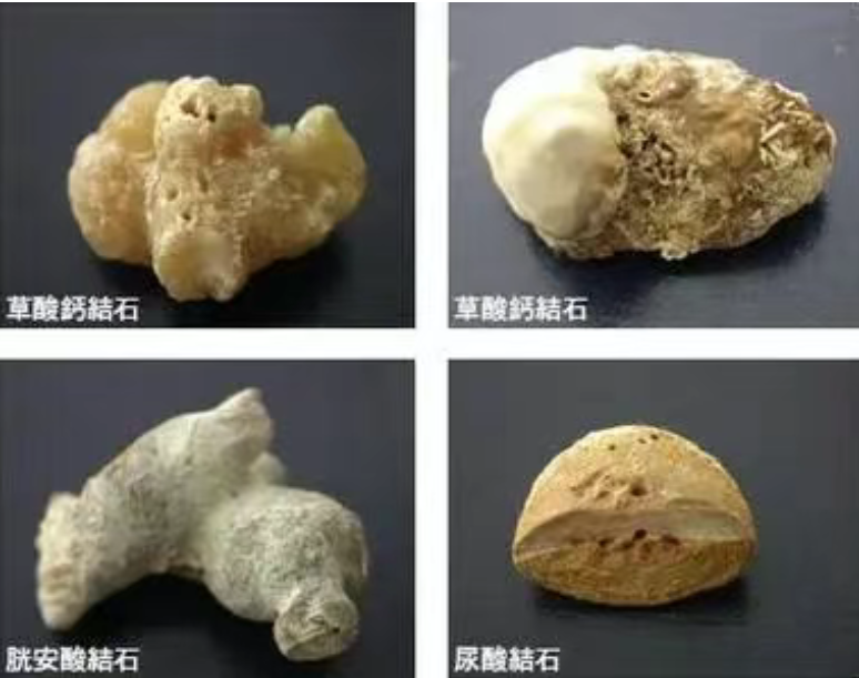 天冷总忘喝水？小心肾结石悄悄 “搞偷袭”，一文教你预防