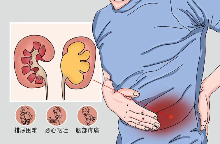 不痛的结石，可能正在悄悄“毁掉”你的肾!