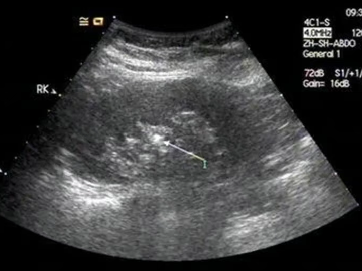 破案了！为什么有些人明明有肾结石B超却找不到？