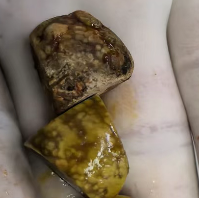 一男子反复腹痛数年痛苦不堪，我院成功从其胆囊内取出“枣核”大结石