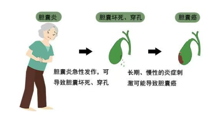 长期不吃早餐，易长胆囊结石，警惕癌变风险